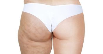 Reduzir a gordura localizada é o suficiente para exterminar a celulite? vencer a celulite gordura localizada