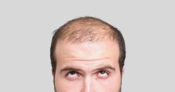 Dicas de alguém que conseguiu melhorar a calvície (ficar careca)